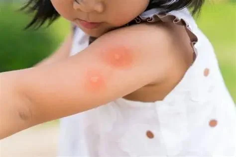 How to Prepare for Insect Bites and Stings While Camping