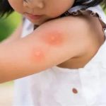How to Prepare for Insect Bites and Stings While Camping