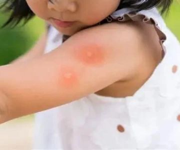 How to Prepare for Insect Bites and Stings While Camping